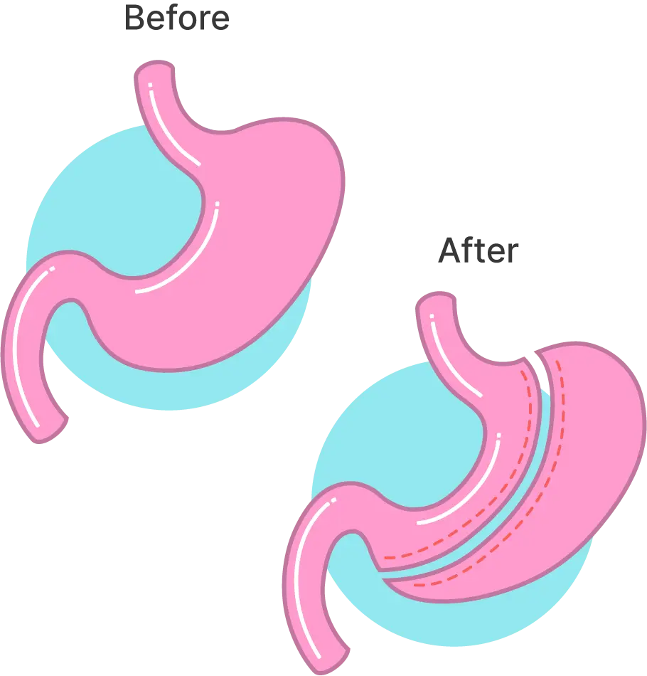 stomach before and after gastric sleeve
