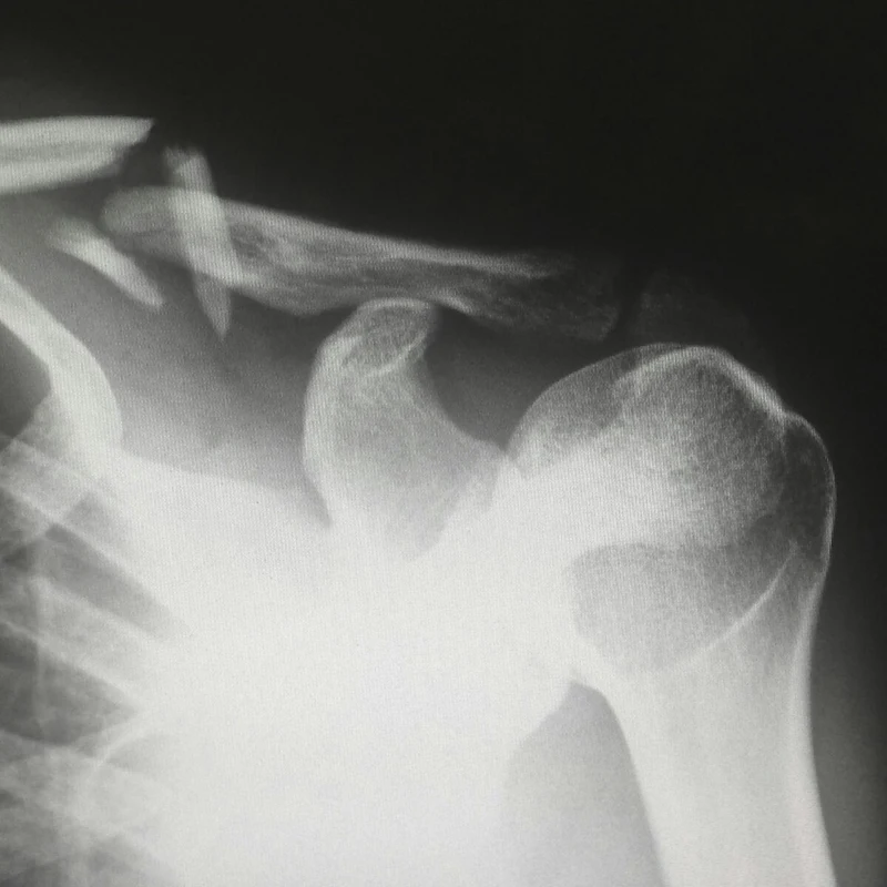 shoulder-x-ray